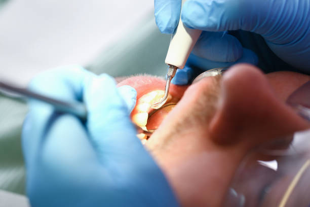 Best Emergency Wisdom Tooth Extraction in Brewerton, NY